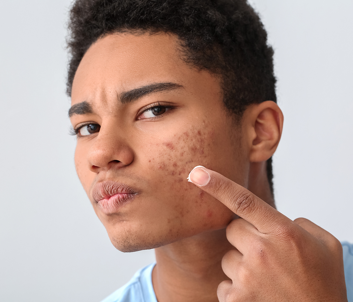 Treatment options for acne scars