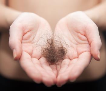 Alopecia Areata Treatment for Hair Loss from Washington DC Dermatologist