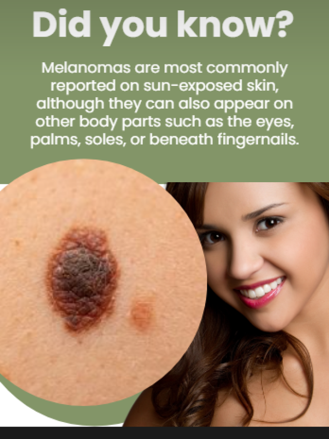 Did you know? Melanomas are most commonly reported on sun-exposed skin