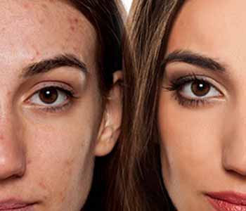 Dermatologist in Annapolis can help clear up acne