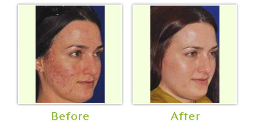 Actual Before And After Results Of Scar Removal Near Me in Washington Area
