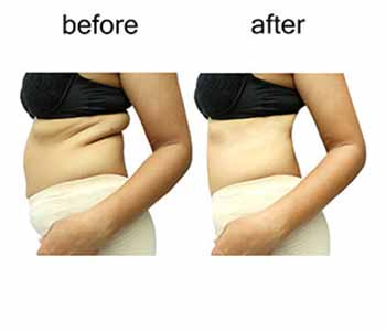 Non invasive body contouring solutions for DC area patients before and after image