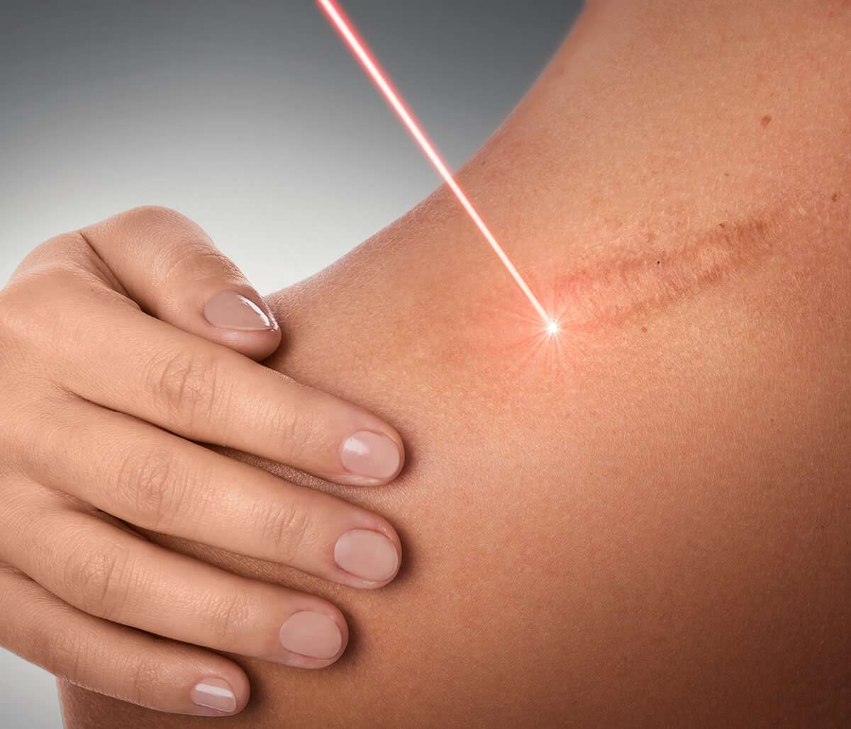 Enjoy Laser Scar Removal with Professional in Washington, DC, Area