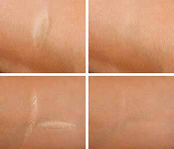 reduce the appearance of various types of scars