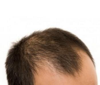 Scalp Micropigmentation Treatment for Thinning Hair from Washington DC Dermatologist