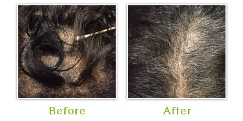 Alopecia - Before and after results