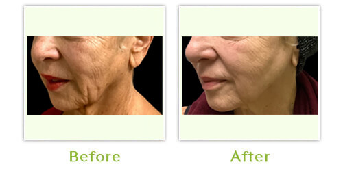 Anti-aging skincare Before After Images,1, Center for Dermatology & Dermatologic Surgery