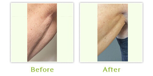 Anti-aging skincare Before After Images,2, Center for Dermatology & Dermatologic Surgery
