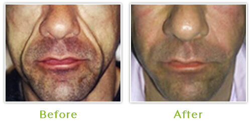 Sculptra Annapolis - Before and After - Case 1