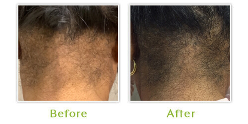 Hair Loss - Before and after results - Case 1