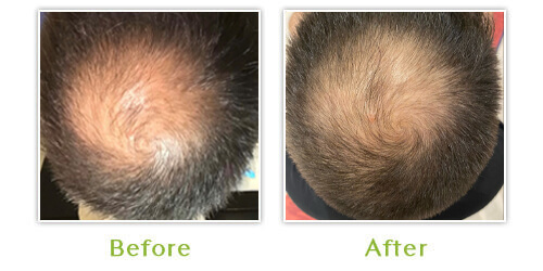 Hair Loss - Before and after results - Case 2