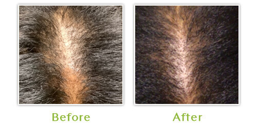 Hair Loss - Before and after results - Caase 3
