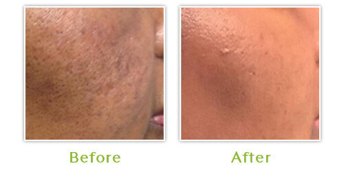 INFINI skin tightening - Before and after results - Case 1