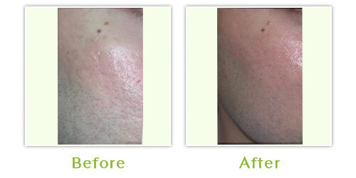 INFINI skin tightening - Before and after results - Case 2