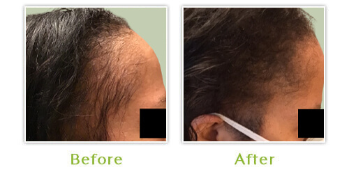 Hair Loss - Before and after results - Case 5