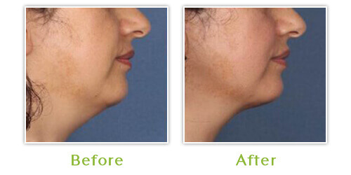 Fat Reduction Solution DC - Kybella Case 3