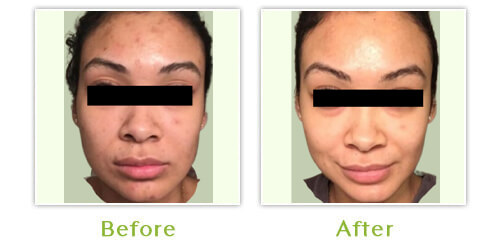 Pregnancy Acne - Before and after results