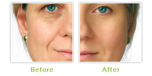 Botox Washington - Before and After - Case 2