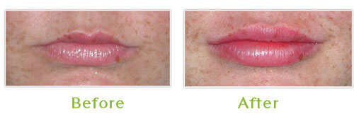 Facial Filler Injections DC - Before and After - Case 1