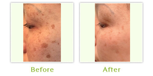 Skin Pigmentation Before After Images,1, Center for Dermatology & Dermatologic Surgery