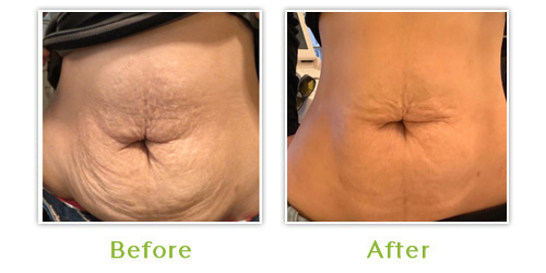 Non-Surgical Tummy Tuck, Filler + skin tightening Before and After