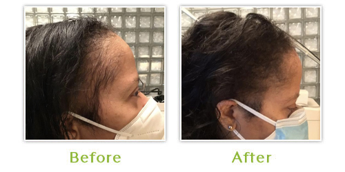 Hair regrowth with PRP (Platelet Rich Plasma) - 3