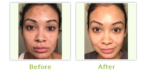 Acne Before & After 2