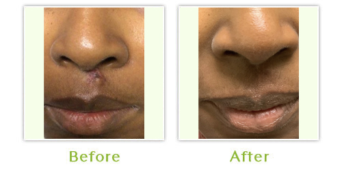 Aerolase Treatment Before & After 1