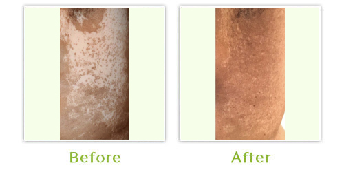 Vitiligo Before & After 2