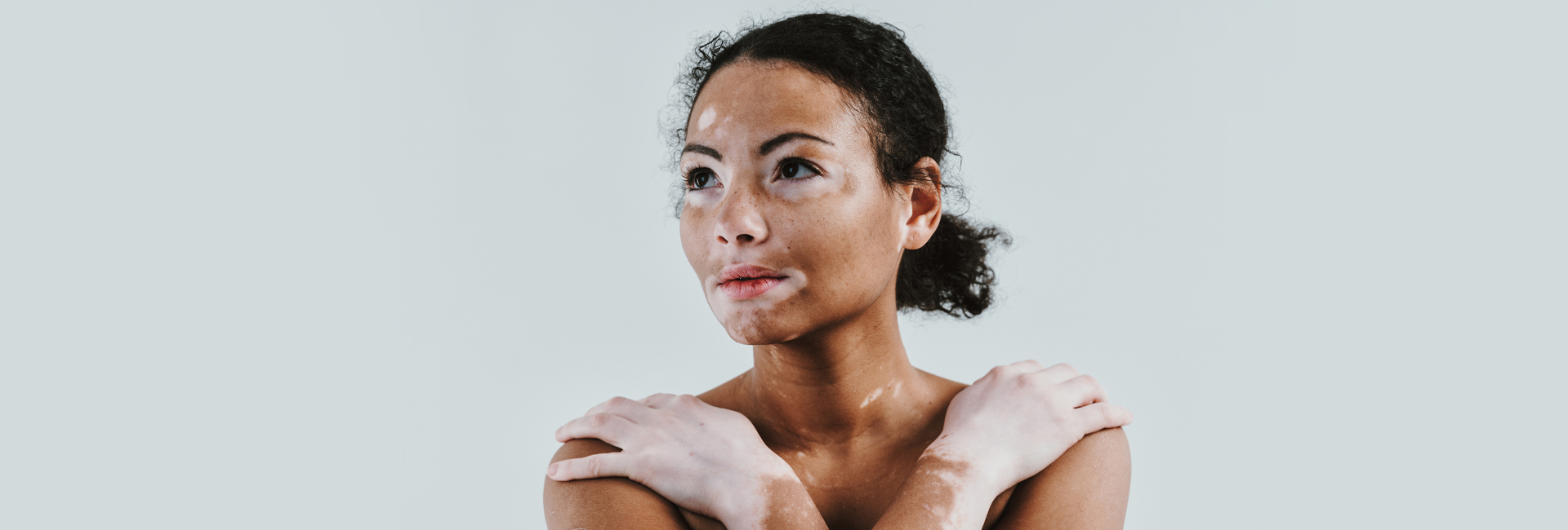 The diagnosis and treatment of vitiligo